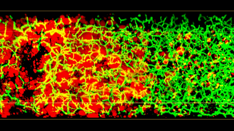 3D-Bild der Lipidtröpfchen (rot) und des Gallenkanalnetzwerks (grün) entlang der Leberläppchen eines Patienten mit nicht-alkoholischer Fettlebererkrankung (NAFLD). 