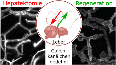Schematische Darstellung zu Hepatektomie und Regeneration der Leber; Hintergrund: Mikroskopbild gedehneter Gallenkanälchen