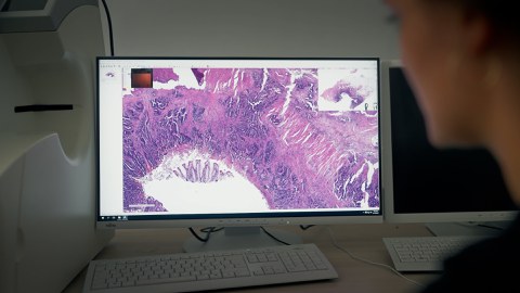 Foto eines Arbeitsplatzes mit einem Monitor, auf dem das histopathologische Bild eines Tumors zu sehen ist.r