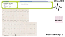 im E-Learning angezeigte 12-Kanal-EKG 